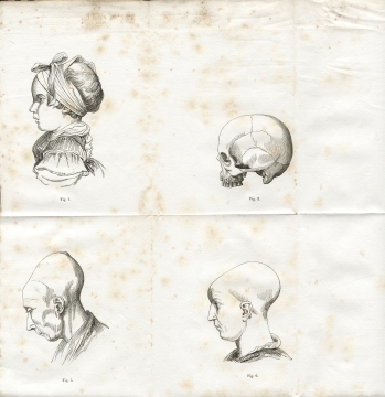 Fig. 1-2-5-6 - A. Foville : Déformation du crâne... (1834)