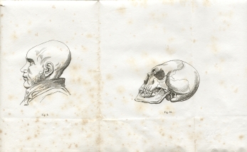 Fig. 9-10 - A. Foville : Déformation du crâne... (1834)