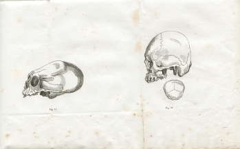 Fig. 11-12 - A. Foville : Déformation du crâne... (1834)