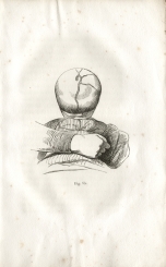 Fig. 13 - A. Foville : Déformation du crâne... (1834)